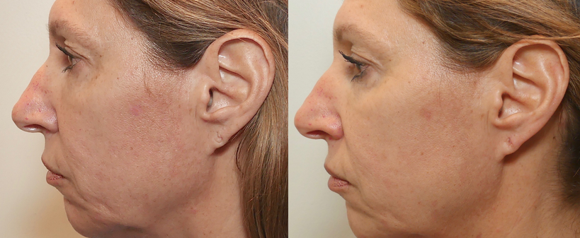 6cdf983e-m8facetite-bforley-faceneck-56fem-1_10mr0e60mr09d00002e000.png